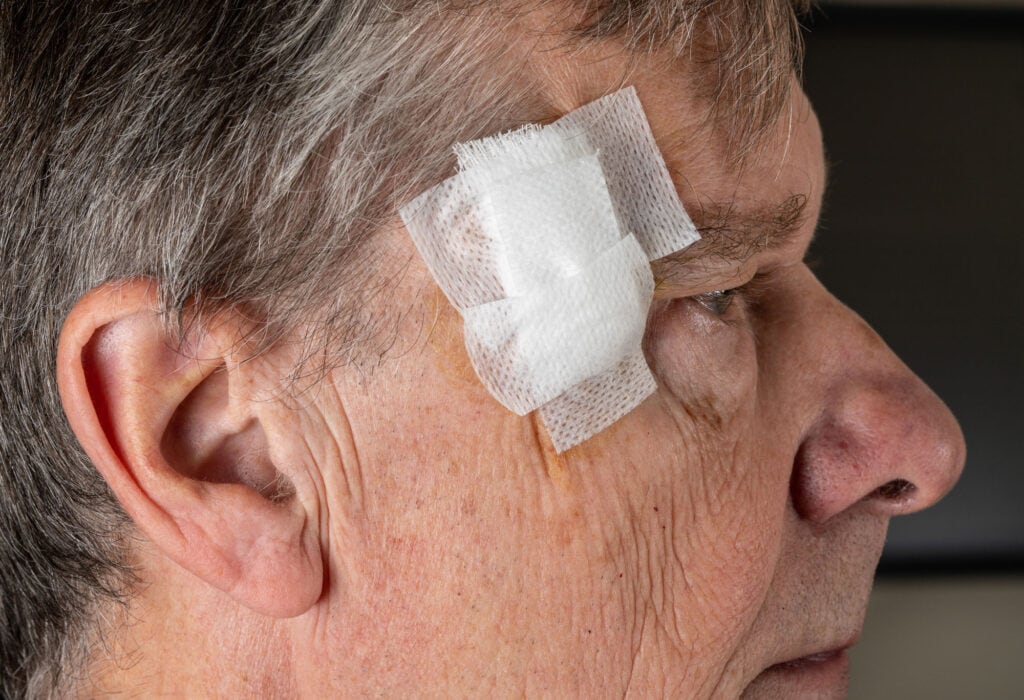 Patient with a facial bandage during Mohs surgery recovery after skin cancer removal on the temple